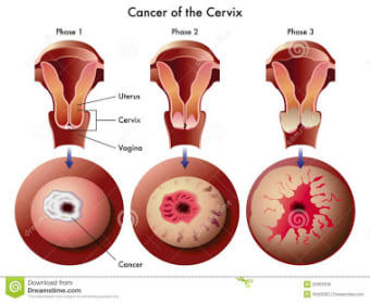 Cervical Cancer - News/Videos0