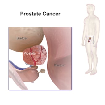 Prostate Cancer - News/Videos0