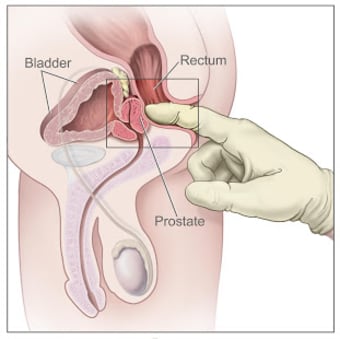 Prostate Cancer - News/Videos1