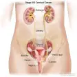 Cervical Cancer - News/Videos